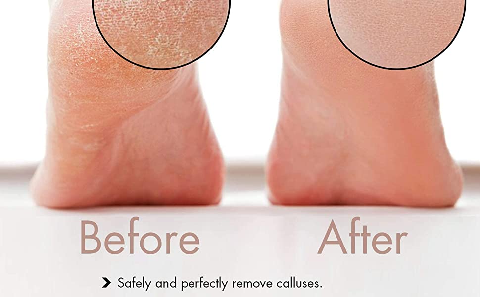 Rechargeable Foot Callus Removal and Dead Skin Removal Pedi Roller Care, Pedi Feet Care for Removes Dry Hard & Dead Skin Ideal Gift