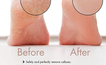 Rechargeable Foot Callus Removal and Dead Skin Removal Pedi Roller Care, Pedi Feet Care for Removes Dry Hard & Dead Skin Ideal Gift
